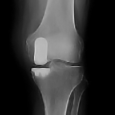 protesi monocompartimentale ginocchio